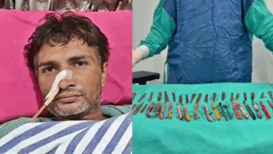 Photo of UP में एक शख्स के पेट से निकले ब्रश, पेन और चम्मच… डॉक्टर भी रह गए दंग